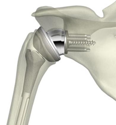 reverse-total-shoulder-replacement